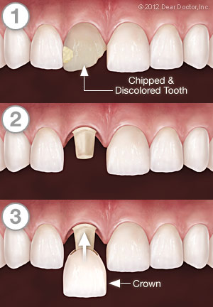 Dental Crowning