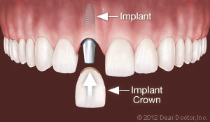 Implants replace one tooth