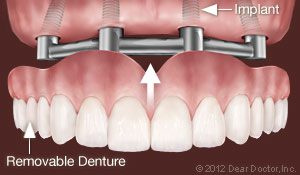 Implants upport Removable Dentures