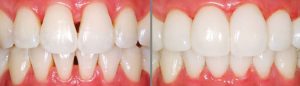 Bioclear Before and After